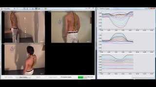 Spine Analysis in Real Time and 3D  with Simi Motion [upl. by Amoritta]