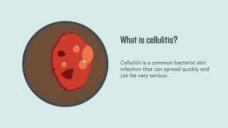 Cellulitis Causes Symptoms Diagnosis and Treatment  Merck Manual Consumer Version Quick Facts [upl. by Nyraa394]