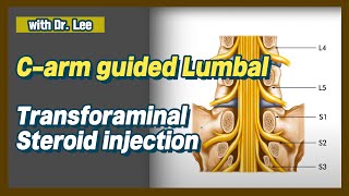 lumbar L5 transforaminal L5S1 facet joint injection C arm lecture amp clinical case [upl. by Laural153]