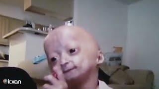 Adalia Rose Austinite social media star with rare genetic condition dies at 15 [upl. by Tyrone]