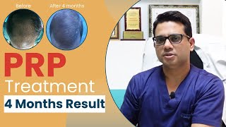 PRP treatment results after 4 months  PRP for hair growth in Delhi  Hair transplant in Delhi [upl. by Doe]