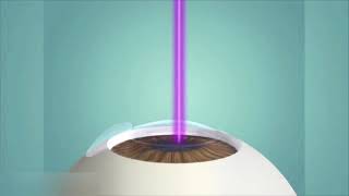 Lasik et PresbyLasik  Opération laser des yeux  Myopie astigmatisme hypermétropie et presbytie [upl. by Allie469]