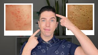 How to Get Rid of Acne Scars [upl. by Macguiness]