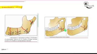 Mandibular Fractures  Part 2 MANAGEMENT [upl. by Inman445]