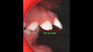 Amazing two phase treatment of Sever Class II Div 1  lama 10Y [upl. by Enoek995]