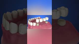 Tooth supported fixed bridge instalation process medicalanimation health dentist [upl. by Nala159]