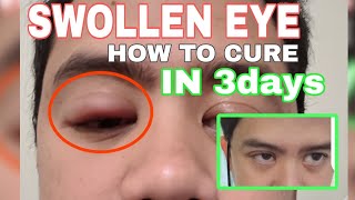 SWOLLEN EYE  HOW TO CURE  JELSONICADVENTURECA [upl. by Leind]