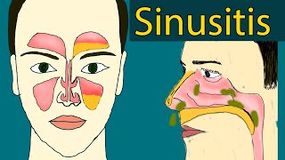 Sinusitis  Symptoms and treatment Sinus Infection Chronic sinusitis [upl. by Nylarat]