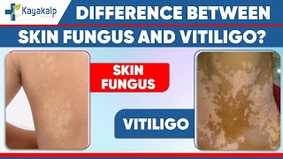 Tinea versicolor Fungal Infection vs Vitiligo Safed daag ka ilaaj  Kayakalp Global [upl. by Lucretia393]