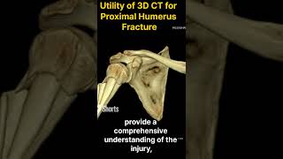 3D CT Scan for Proximal Humerus Communited Fracture [upl. by Damalus766]