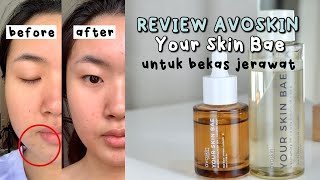 REVIEW AVOSKIN Your Skin Bae ampuh BANGET untuk bekas jerawat Indonesia [upl. by Kcirdes]