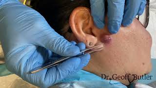 Drainage of an infected cyst in front of the ear [upl. by Fredenburg]