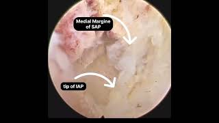 L4L5 interlaminar Endoscopic Decompression Contralateral over the top decompression [upl. by Acinoed]