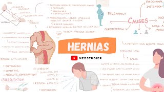 What are hernias  Direct and Indirect  MedStudier [upl. by Akinaj]