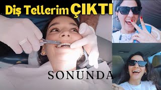 Sonunda Diş Tellerim Çıktı  Retainer amp Şeffaf Plak Dönemi [upl. by Bledsoe102]