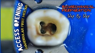 Access Opening Mandibular First Molar  Biomechanical Preparation  step by step [upl. by Ainegul142]