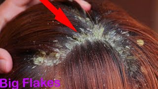 BIG DANDRUFF FLAKES Scalp scratching and picking Satisfying Dandruff Removal  12 [upl. by Koppel316]