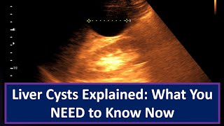 Liver Cysts Explained What You NEED to Know Now [upl. by Ahsinid]