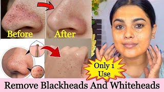 Nose extractions BlackheadswhiteheadsMiliaKeratin plugs extracted with deep squeezepore dirt [upl. by Anerres]