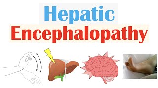 Hepatic Encephalopathy  Pathophysiology Triggers Signs amp Symptoms Diagnosis Treatment [upl. by Jehias]