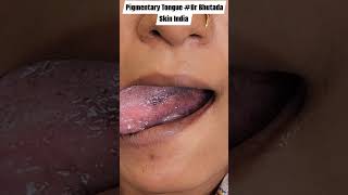 Pigmentary Tongue Dr Bhutada Skin India [upl. by Clellan]