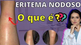 Eritema nodoso O que é O que causa [upl. by Auof]