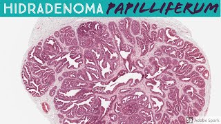 Hidradenoma Papilliferum 5Minute Pathology Pearls [upl. by Aihsercal97]