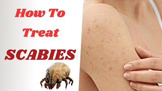 How To Treat Scabies Effectively  From PERMETHRIN Cream To IVERMECTIN Tablets [upl. by Amice454]