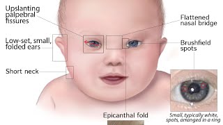 Down syndrome passmedicine [upl. by Seavir]