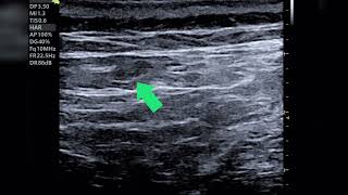 DESGARRO MUSCULAR DE CUADRADO LUMBAR POR ECOGRAFÍA DOLOR DE ESPALDA DE TIPO MUSCULAR [upl. by Nilam]