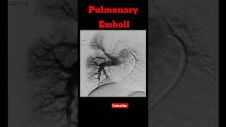 Pulmonary Emboli shorts pulmonaryembolism radiology pulmonarydisease [upl. by Temp]