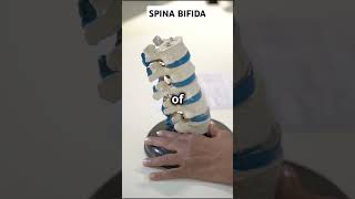 1 Supplement to prevent Spina Bifida spinabifidaawareness facts [upl. by Eirb]