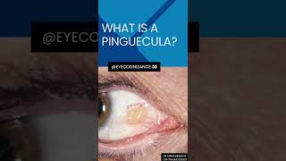 what is a pinguecula ¦eyecognizance [upl. by Gloriane72]