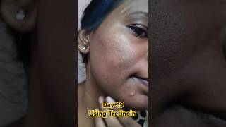 Day19 Using Tretinoin 0025 cream viralvideo tretinoin youtubeshorts skincare shorts [upl. by Spitzer]