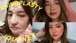 MY RHINOPLASTY JOURNEY 2 WEEKS POSTOP  Andrea Angeles [upl. by Aipmylo]