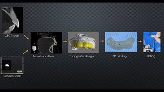 Guided Endodontics Video Demonstration of Complete Clinical Technique [upl. by Enohpesrep]