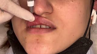 Learn Safe Lip Filler Injections Easy Steps for Perfect Lips [upl. by Jarib]