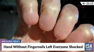 Hand Without Fingernails Left Everyone Shocked  ISH News [upl. by Leong]