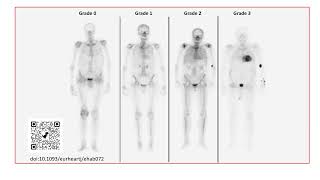 Cardiac amyloidosis multimodality assessment slides only [upl. by Eadie]