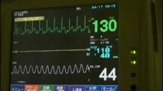 心電図モニター 実際の測定 ST上昇心筋虚血状態FUKUDADENSHI DINASCOPE DS7100 [upl. by Nitsej]