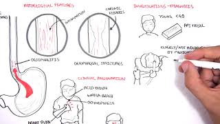 GORD GERD Gastro Oesophageal Reflux Disease  Overview pathophysiology treatment [upl. by Oneladgam]