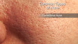 How to Treat Different Types of Acne [upl. by Shuman]