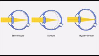 Amétropie hypermétropie myopie astigmatisme presbytie [upl. by Gavin]