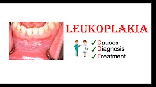 Leukoplakia  Causes Diagnosis amp Treatment [upl. by Annamarie]