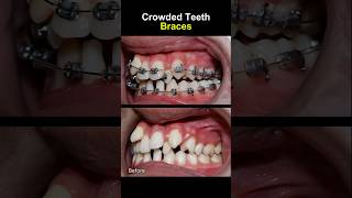 Teeth very crowded and crooked before braces orthodontist braces dentist [upl. by Alcot]