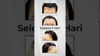 AESTHETIC CLINIC MALAYSIA  Hairline Transplant Day 5 PostSMART™ FUE Lowering Hairline [upl. by Anirdna323]