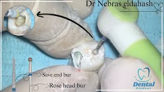 Badly Decayed Lower Molar Access cavity preparation [upl. by Ducan]