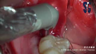 Laser assisted modified inverted pouch technique for ARP1 [upl. by Rebba]