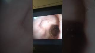 Endoscopy Duodenal quot Bulbarquot Ulcer [upl. by Oetam]