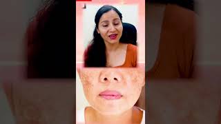 3 Rules In Ayurveda For Pigmentation  Best Natural Treatment Of Pigmentation At Home  Pigmentation [upl. by Lareneg847]